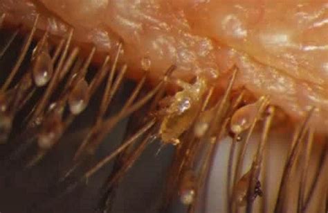 Electron Microscopy Photos Imgur Eye Mites Eyelash Mites Parasite