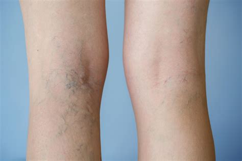 How Can You Get Rid Of Varicose Veins Madison Medispa