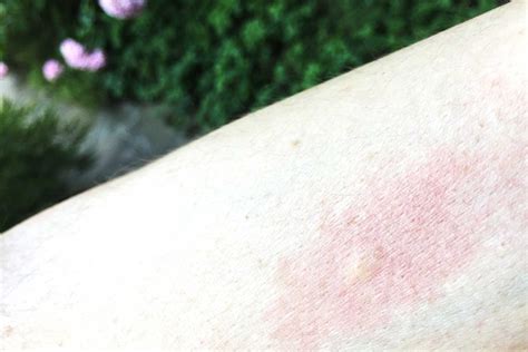 Identifying Bug Bites How To Figure Out What Bit You Best Health Canada