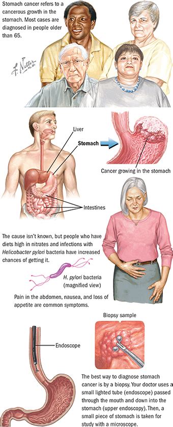 Early Warning Signs Stomach Cancer
