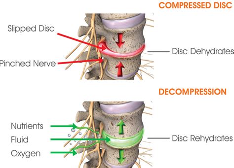 Spinal Decompression Therapy Bodyworks Chiropractic
