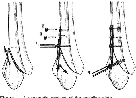 Figure 1 From Comparative Study For The Fixation Method In The Danis