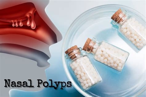 Homeopathic Remedies Medicines Treatment For Nasal Polyps