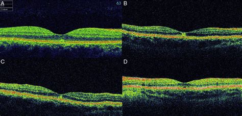 Oct Spectral Domain Optical Coherence Tomography