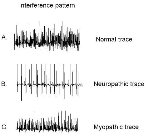 Overview Of The Application Of Emg Recording In The Diagnosis And
