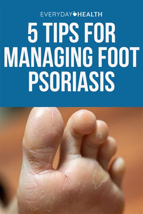 Tips For Managing Foot Psoriasis Everyday Health In 2021 Psoriasis
