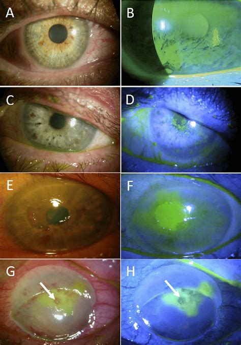 Keratitis is inflammation of the cornea. Stages of neurotrophic keratitis: Impaired cornea ...