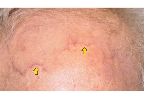 Deadly Skin Cancers