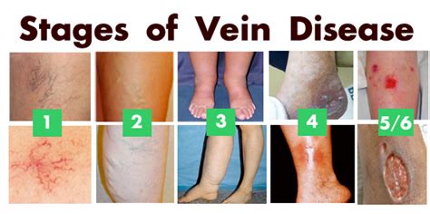 Vein Disease Stages Vein Disease Treatment Center St Louis Mo