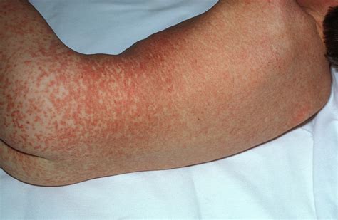 Measles Rash Photograph By Dr Ma Ansaryscience Photo Library Pixels