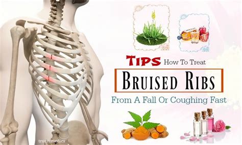 17 Tips How To Treat Bruised Ribs From A Fall Or Coughing Fast