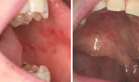 Appearance Of Oral Lesions Indicative Of Erythematous Candidiasis In An