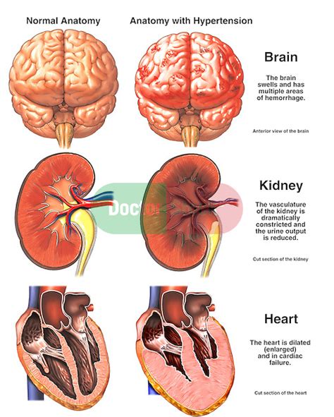 Organ Damage Due To Extreme Hypertension High Blood Pressure Doctor