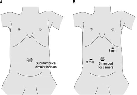 Incision Of Supraumbilical Open Pyloromyotomy Supraumbilical Incision