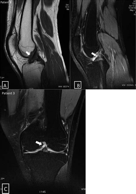 Sagittal Mri Slices In T Weighted A And Proton Density With Fat Download Scientific Diagram