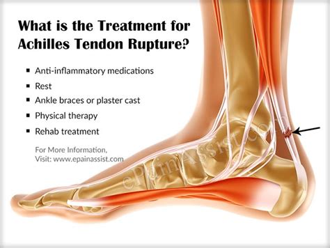 Is Achilles Tendon Rupture A Common Injurycauses Symptoms Treatment