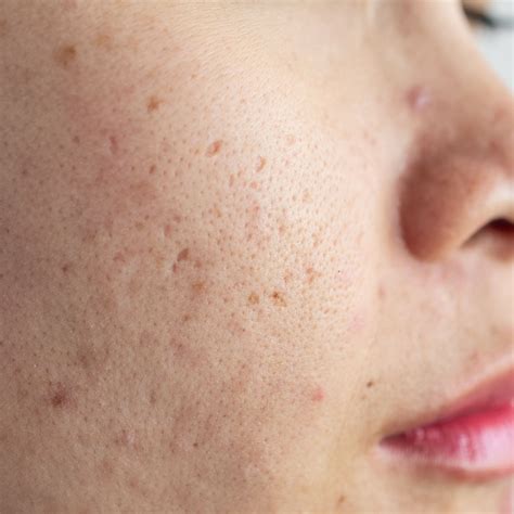 Best Serum For Pitted Acne Scars