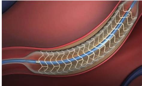 Drug Eluting Stents Sensofar