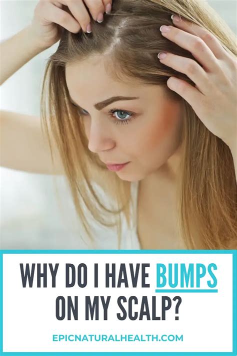 Why Do I Have Bumps On My Scalp How To Get Rid Of Scalp Acne