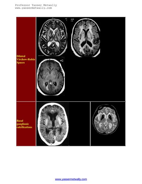 Radiological Pathology Of Ischemic Microvascular Brain Diseasean Update