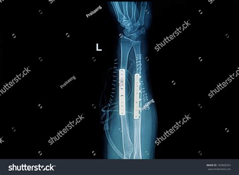 Xray Image Forearm Implant Plate Screw Stock Photo 183968354 Shutterstock