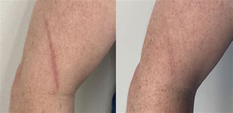 Laser Stretch Mark Removal Treatment London Premier Laser