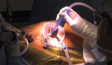 Minimally Invasive Keyhole Technique The Centre For Heart Surgery Western Australia