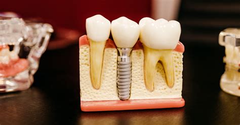 How Long Do Dental Implants Last For Bespoke Smile