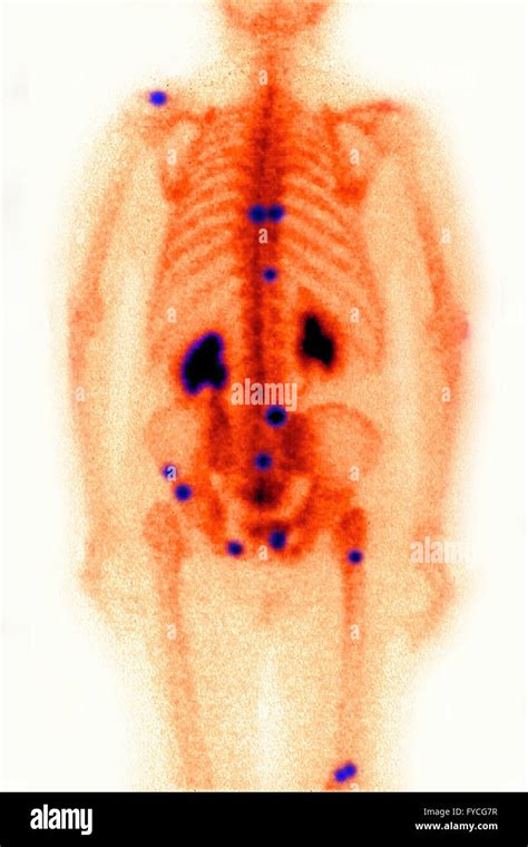 Gamma Scan Of Bone Cancer Hi Res Stock Photography And Images Alamy