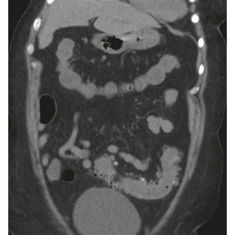 Ct Abdomen And Pelvis Without Contrast Showing Mild Inflammation