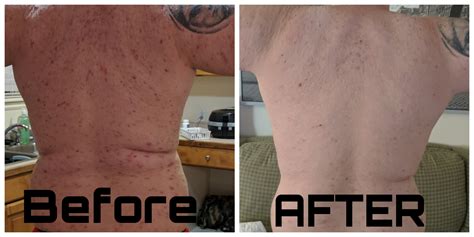 6 Months Progress For Severe Back Acne Accutane