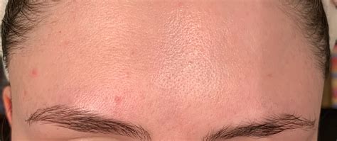Acne Help With Persistent Acne Rskincareaddiction