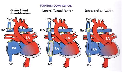 Pin By Nonas Arc On Hypoplastic Right Heart Syndrome Atrial Septal