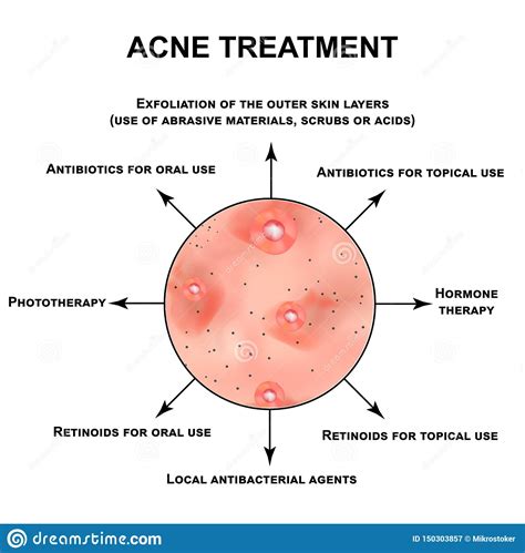 Acne Treatment Pustules Papules Comedones Blackheads Acne On The