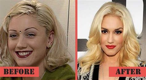 Gwen Stefani Plastic Surgery Nose Job Botox After And Before