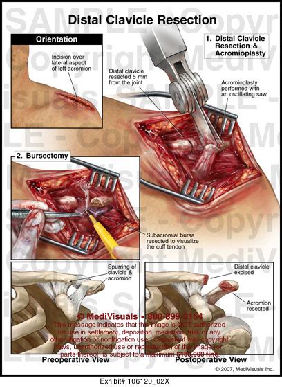 Distal Clavicle Resection Medical Illustration Medivisuals