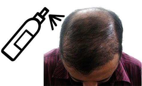 7 Best Bald Spot Spray Products Reviewed For You