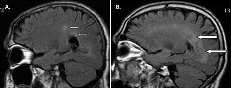 Neuroinflammatory events after anti-TNFα therapy | Annals of the