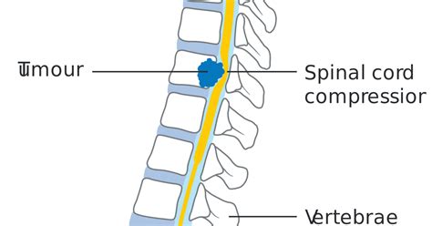 Backbone of complex networks of corporations: Diagram Of Backbone / Scoliosis Flat Vector Illustration ...