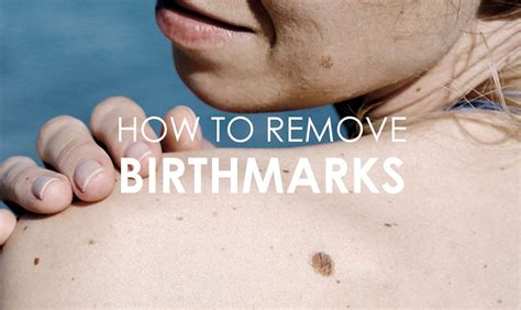 Birthmark On The Face Types Meaning And Treatments Premier Clinic