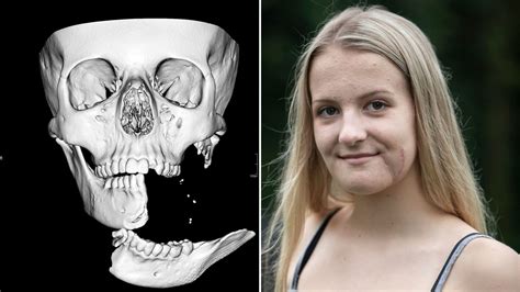 Girls Jaw Hung By 1cm Of Skin After Horse Riding Accident Flipboard