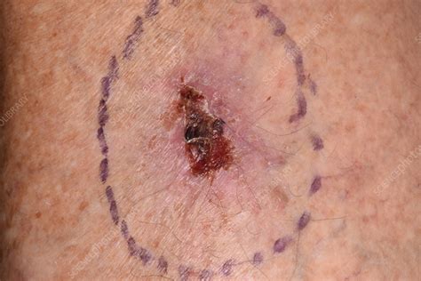 Squamous Cell Carcinoma Marked Before Skin Excision Surgery Stock