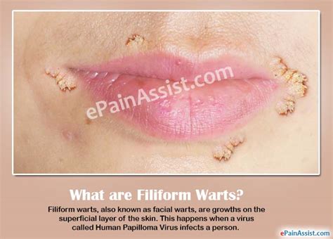 Filiform Wartscausessymptomstreatmenthome Remediesis It Contagious