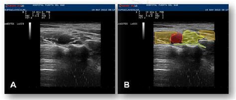 A Ultrasound Anatomy Of The Supraclavicular Brachial Plexus B