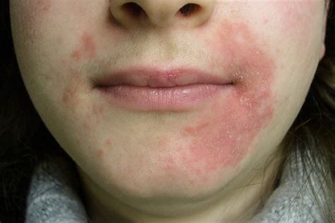Perioral Dermatitis Skin Rash Around The Mouth Healthhype Com My XXX