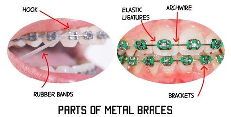 Parts Of Metal Braces Jaipur Root And Tooth Ortho Braces Treatment By