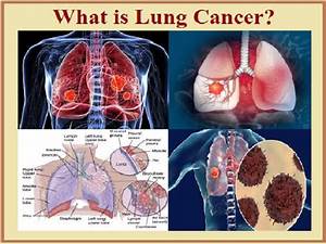 Lung Cancer: Symptoms, Causes, Stages, Treatment and more Lung Cancer  