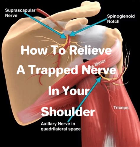 How To Relieve A Trapped Nerve In Your Shoulder 2022