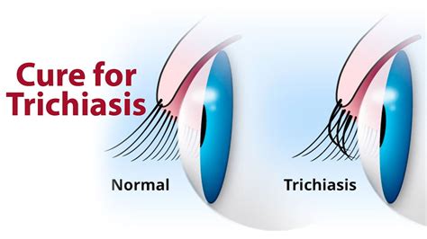 Cure For Trichiasis Zyropathy Care World Tv Youtube