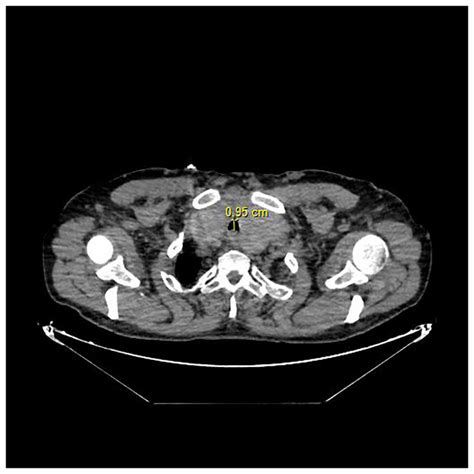 Computed Tomography Of The Neck Illustrating Enlarged Thyroid Gland